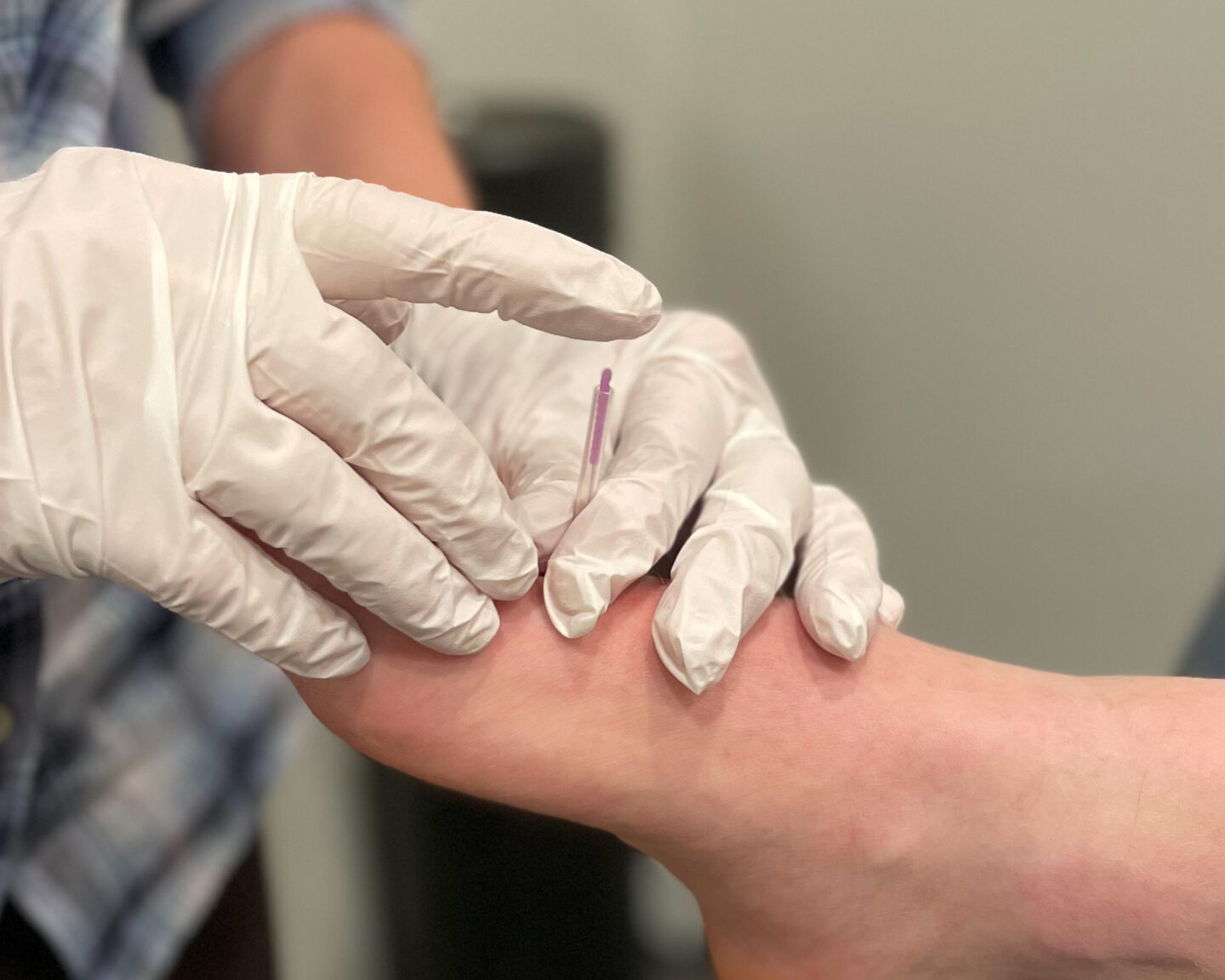 Is IMS or Dry Needling Right For Me North 49 Physical Therapy 